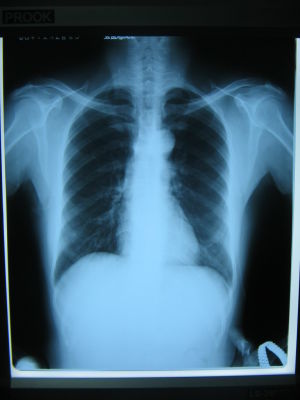 пленки рентгеновские медицинские для маммографии фото